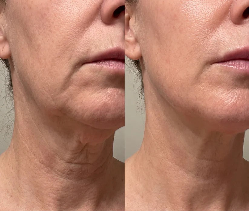 LED Face & Neck Sculpting Device with EMS & Heat Therapy
